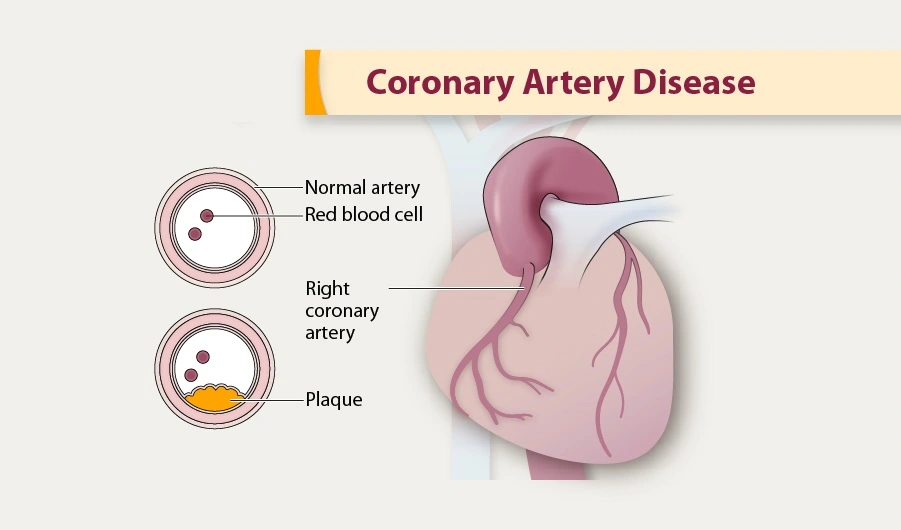 Common Heart Screenings For Detecting Coronary Artery Disease