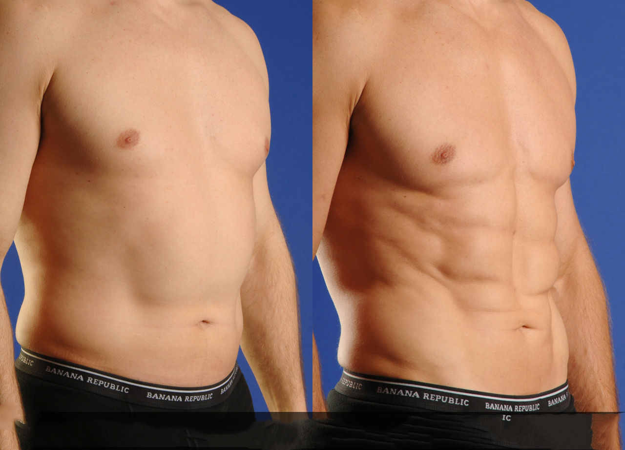 Enjoy Gaining a Perfect Shape by Undergoing Tummy Tuck Surgery